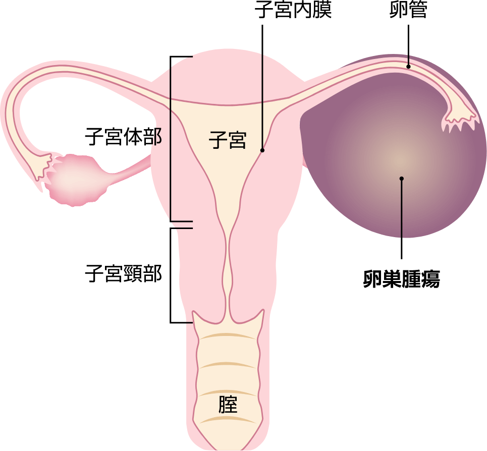 全 子宮 摘出 卵巣