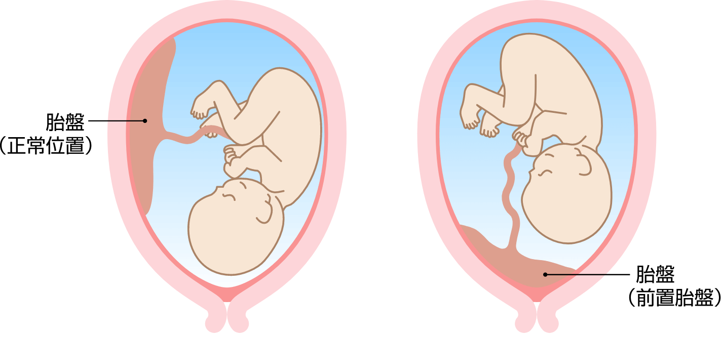 胎盤停滞の兆候と診断の障壁